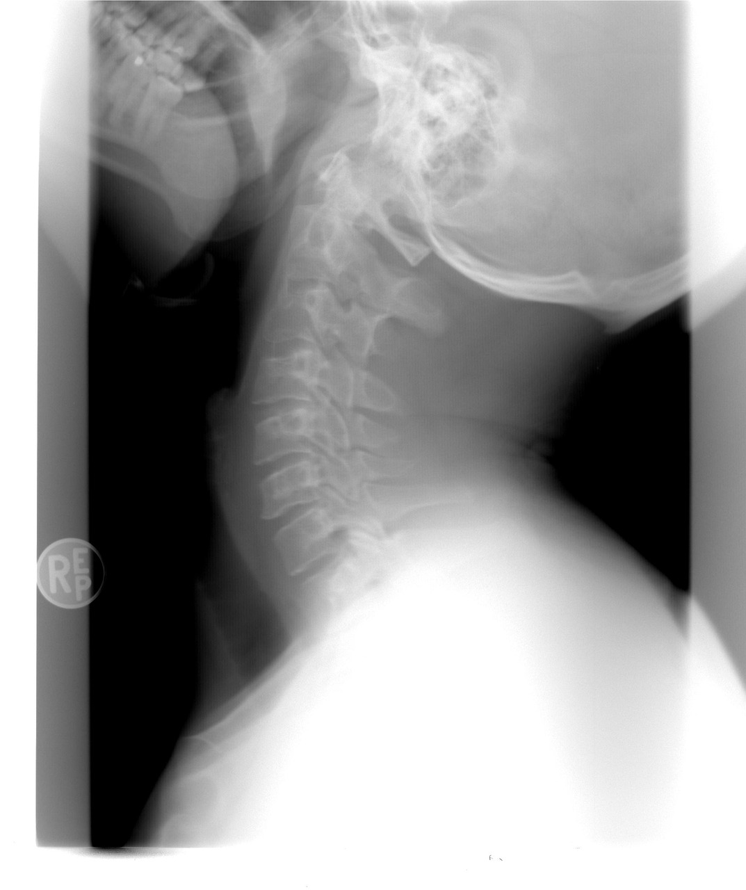 radiografía de cervicales
